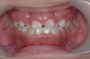 つくば・土浦の矯正歯科　つるみ矯正歯科　歯並び矯正症例A　叢生（乱杭歯）1a